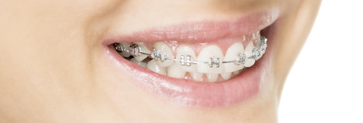 Bagues Dentaires - Appareil Dentaire Métallique