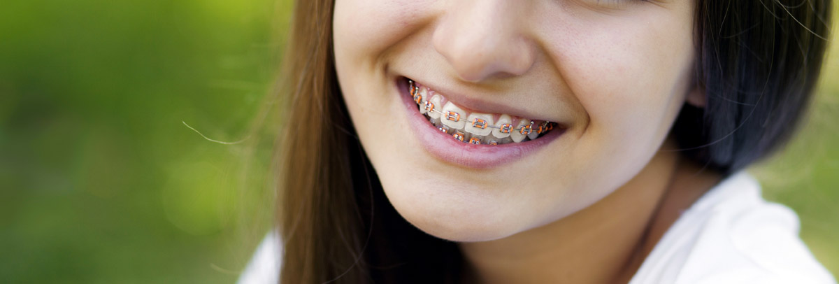 Appareil Dentaire Métallique : Les Bagues Dentaires