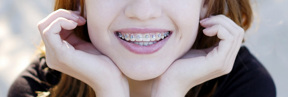 appareil dentaire métallique - bagues dentaires