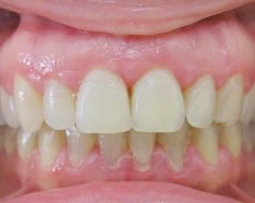 Après Appareil Dentaire Invisible : Bagues Dentaires Céramique Transparente