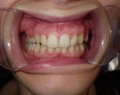 Traitement par Bagues Dentaires Dents Ectopiques