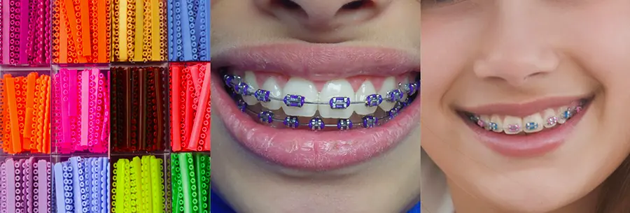 Appareils Orthodontiques Pour Les Couleurs Des Dents ORTHODONTIE PAR