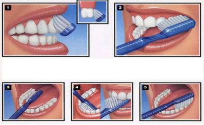 Brossage des Dents Sans Bagues Dentaires