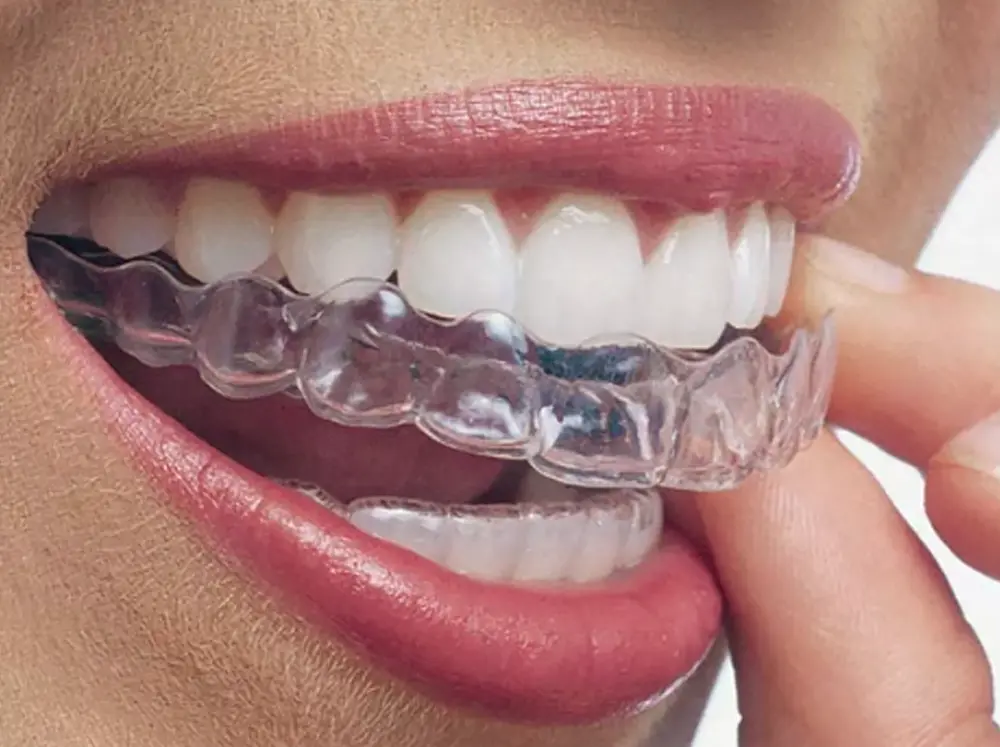Invisalign : Gouttières Dentaires Transparentes