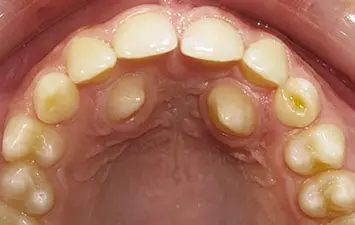 Dent Ectopique Orthodontie Enfant