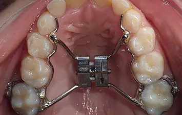 Appareil Dentaire Enfant Disjoncteur